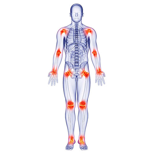 Myofascial Pain